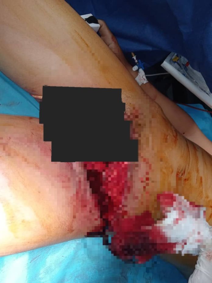 Casi pierde los genitales durante accidente de moto en la Av. Venezuela