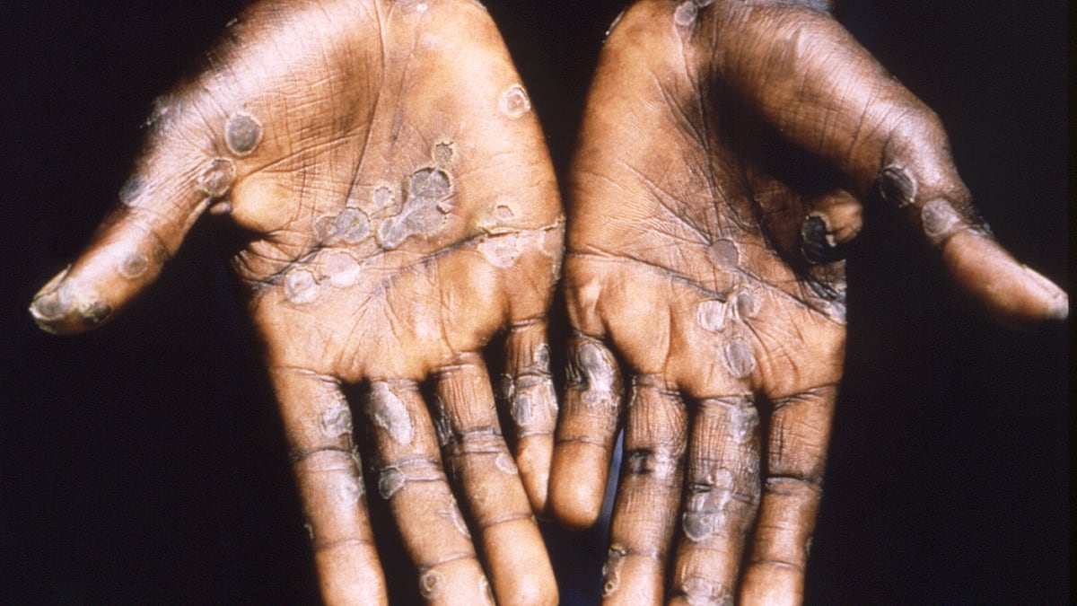 Detectan el primer caso de viruela del mono fuera de África
