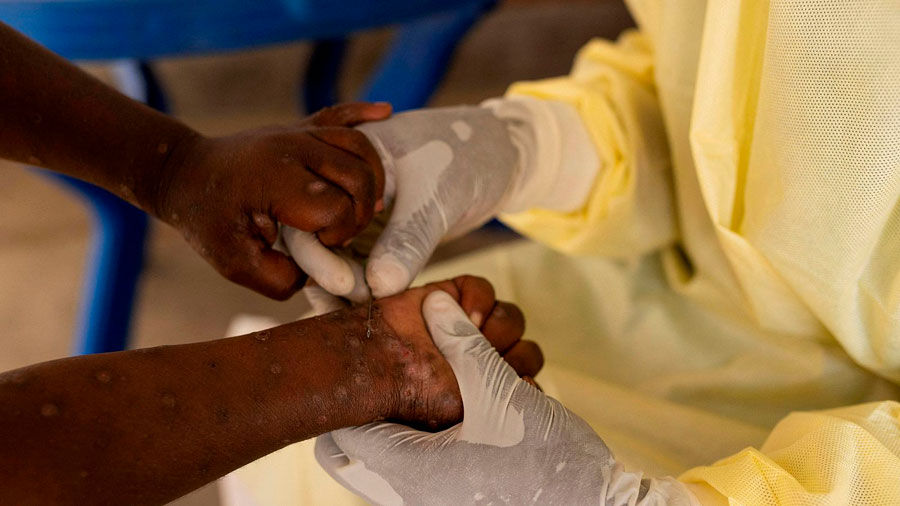 OMS lanza Plan Estratégico Mundial para contener el brote de mpox