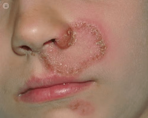 Micosis