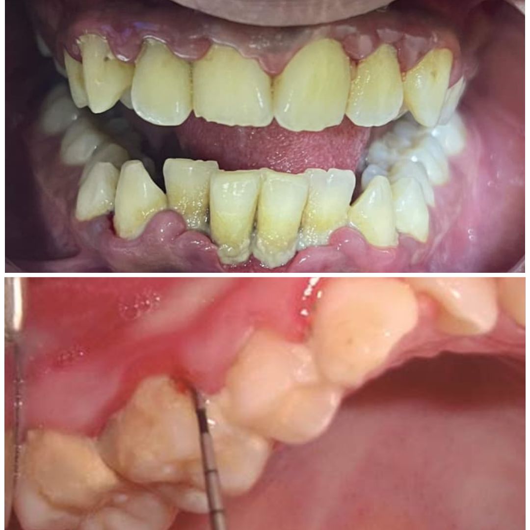 La Gingivitis: un problema doloroso