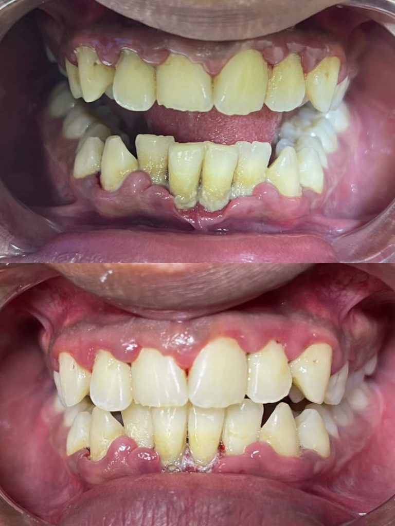La Gingivitis: un problema doloroso