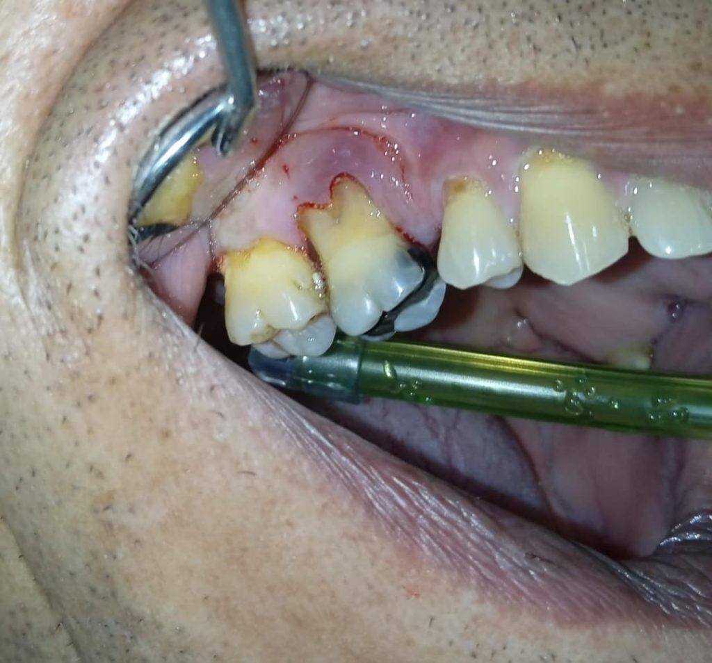 Gingivitis: paciente perdió su pieza dental