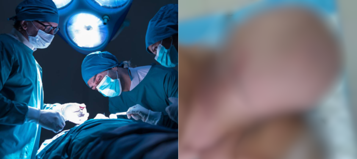 Hombre se quita un tumor del tamaño de su cabeza que médicos ignoraron por 16 años