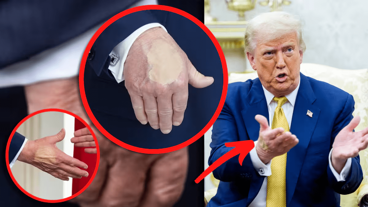 La misteriosa mancha en la mano de Trump y las señales sobre su salud